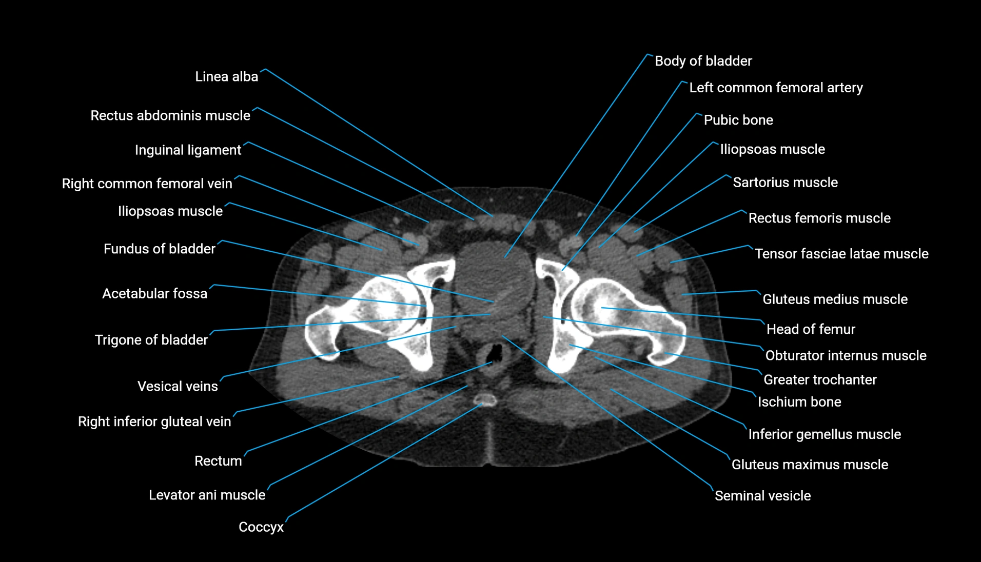 CT urogram axial cross sectional anatomy  labelled radiology image-00240.webp